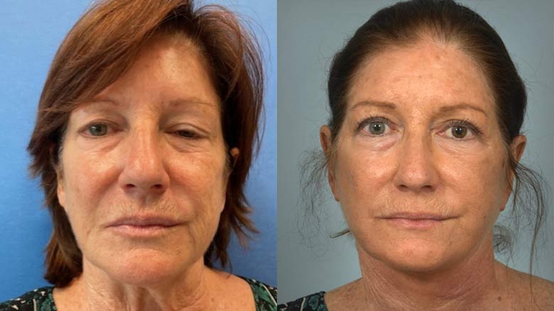Before and after facial paralysis treatment at Cleveland Clinic.
