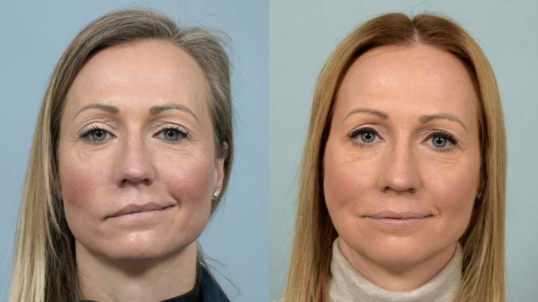 Before and after facial paralysis treatment at Cleveland Clinic.