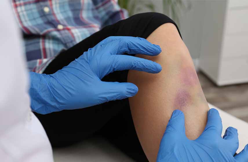 Large bruise on a child's shin just below the knee, appearing purple and red-ish in color.