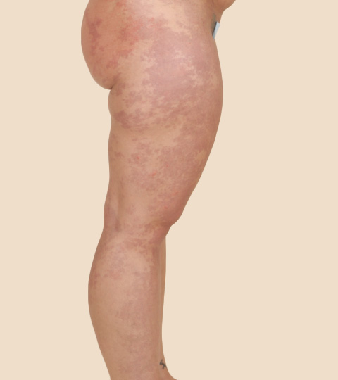 Liposuction -  Side View - Before