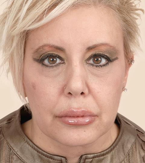 Liposuction -  Front View - After