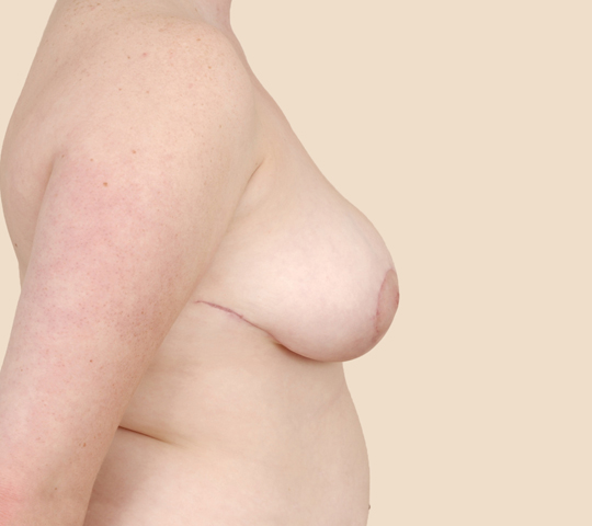 Breast Reduction - Side View - After