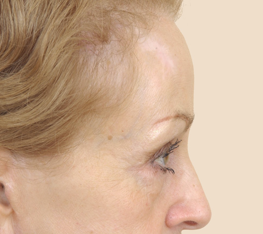 Forehead/Eyebrow Lift: Plastic Surgery | Cleveland Clinic