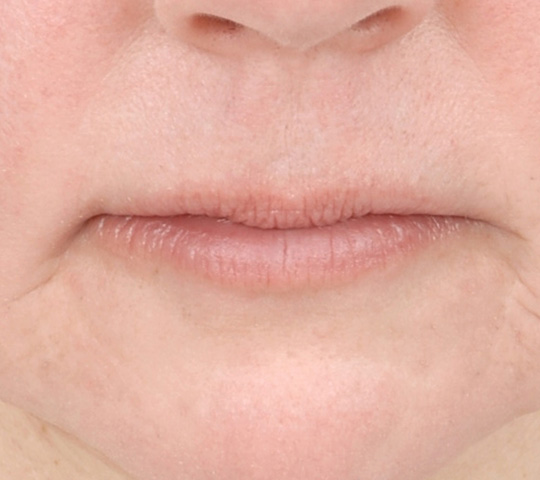 Lip Lift Surgery: Plastic Surgery | Cleveland Clinic