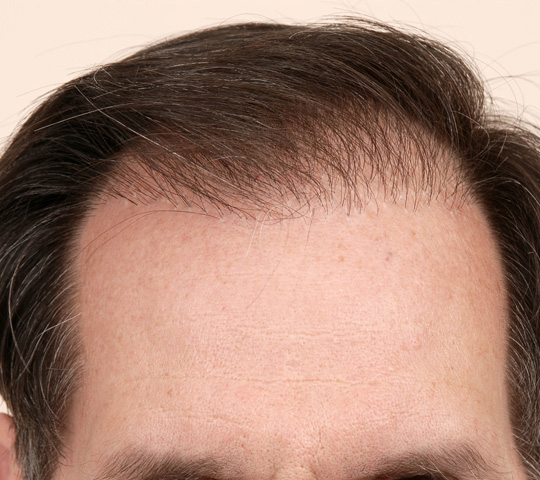 Hair Replacement Surgery | Cleveland Clinic