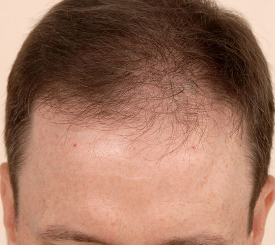 Regrow Hair: PRP Therapy | Cleveland Clinic