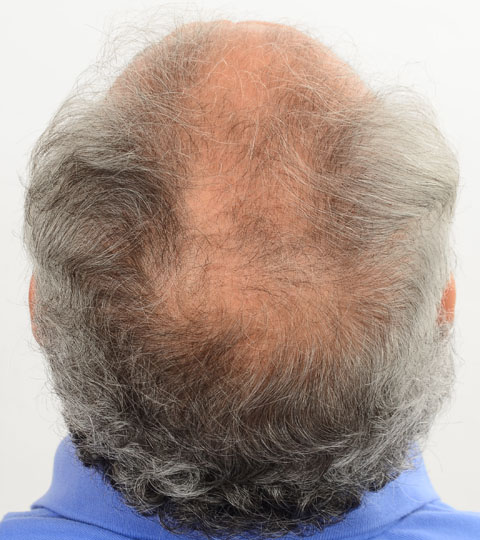 Regrow Hair: PRP Therapy | Cleveland Clinic