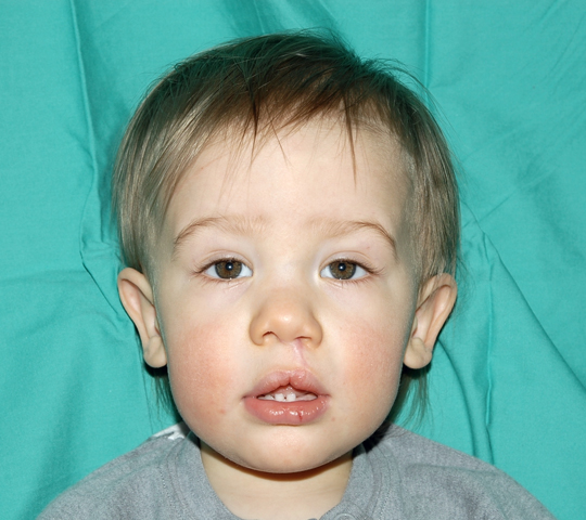 Cleft Lip Palate And Craniofacial Program Cleveland Clinic