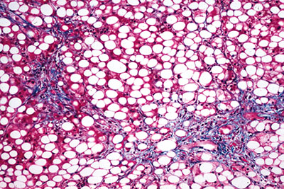 Figure 1. Histologic findings in alcoholic fatty liver disease include fat accumulation in hepatocytes.
