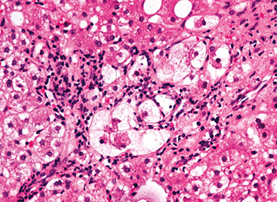 Figure 2. Inflammation and necrosis in the centilobular region of the hepatic acinus.