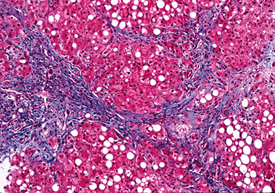 Figure 3. Histology of end-stage alcoholic cirrhosis.
