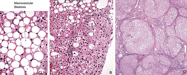 Figure 2: Spectrum of disease in NAFLD. A: Simple steatosis. B: Nonalcoholic steatohepatitis (NASH). C: Cirrhosis. (Image courtesy of Lisa M. Yerian, MD)
