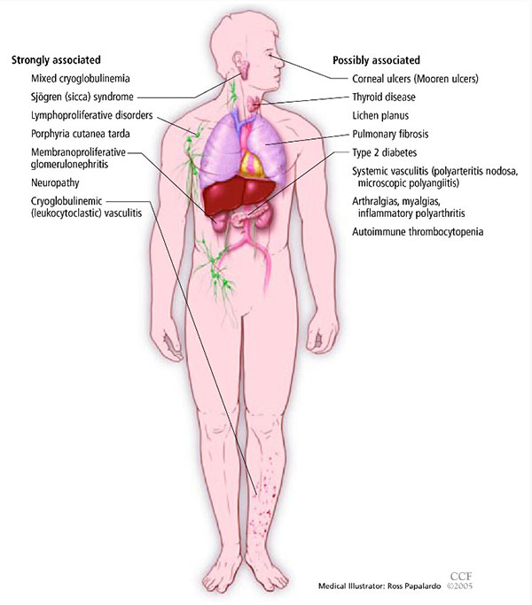 Figure 3:  Extrahepatic manifestations of hepatitis C.  (Image Courtesy of Cleveland Clinic Journal of Medicine)