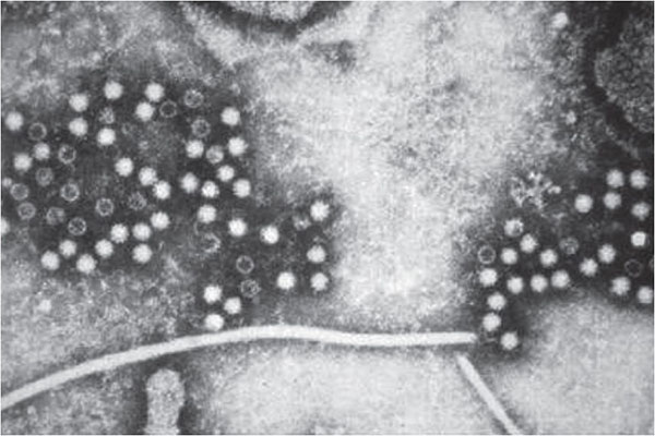 Figure 4: Hepatitis E particles in stool.