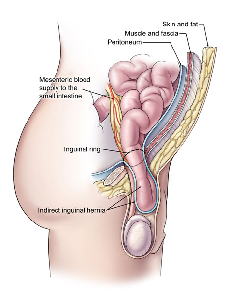 peritoneal cancer hernia)