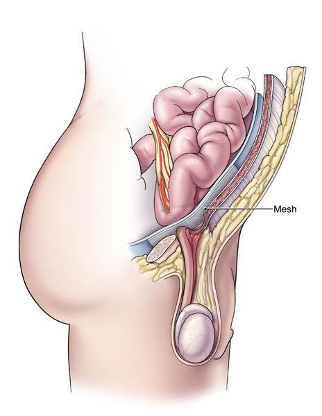 Timing Of Return To Work After Hernia Repair Recommendations