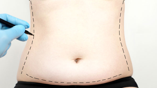 FAQs About Post-Bariatric Body Contouring