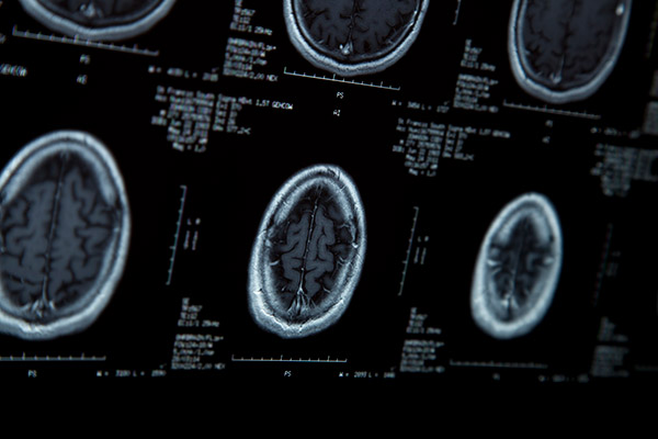 Brain Screening Images