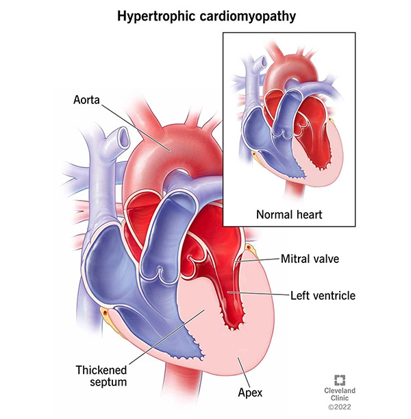Diagram of hypertrophic cardiomyopathy