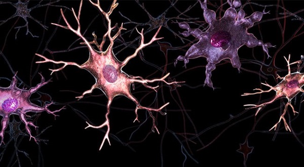 alzheimer's brain image