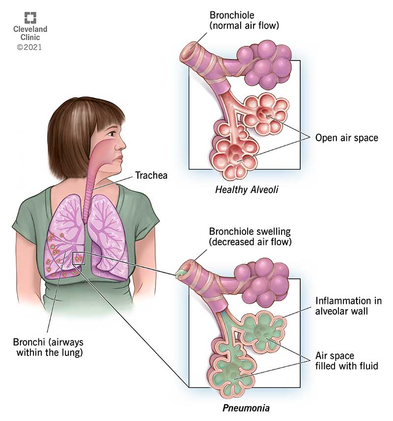 Illustration of healthy vs pneumonic alveoli & bronchioles.