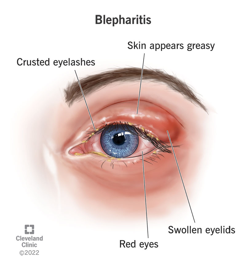Blepharitis symptoms include greasy-looking and swollen eyelid skin, crusted eyelashes and redness in the whites of your eyes.