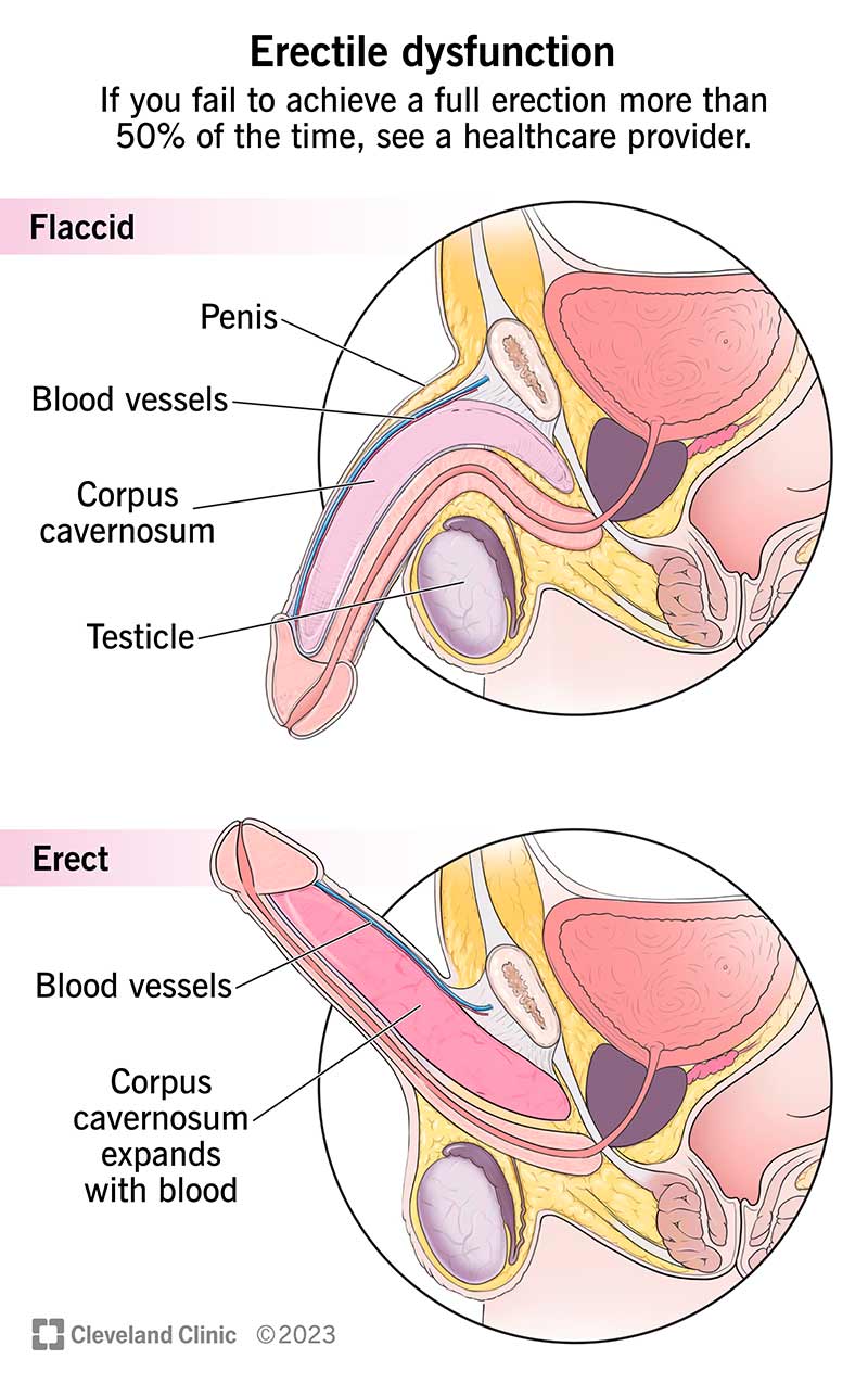 The most common type of erectile dysfunction affects your blood vessels, which carry blood to your erectile tissue.