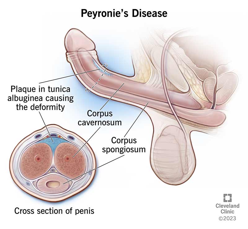 Peyronie’s disease usually causes your penis to curve upward when you have an erection.