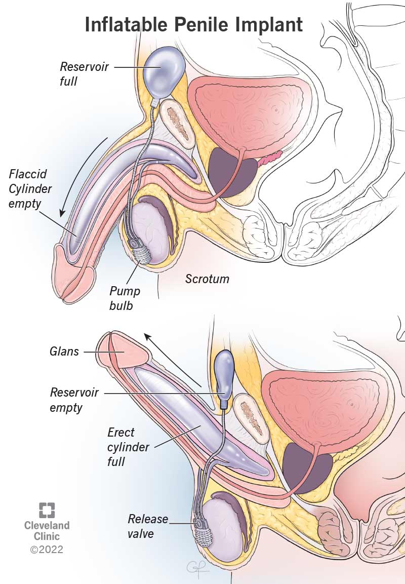 Inflatable penile implants use a pump to send fluid from a reservoir into cylinders in your penis to get an erection.