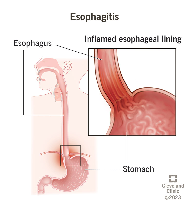 Your esophagus is the pipe food travels down to your stomach. Acid that escapes your stomach into your esophagus can cause esophagitis.