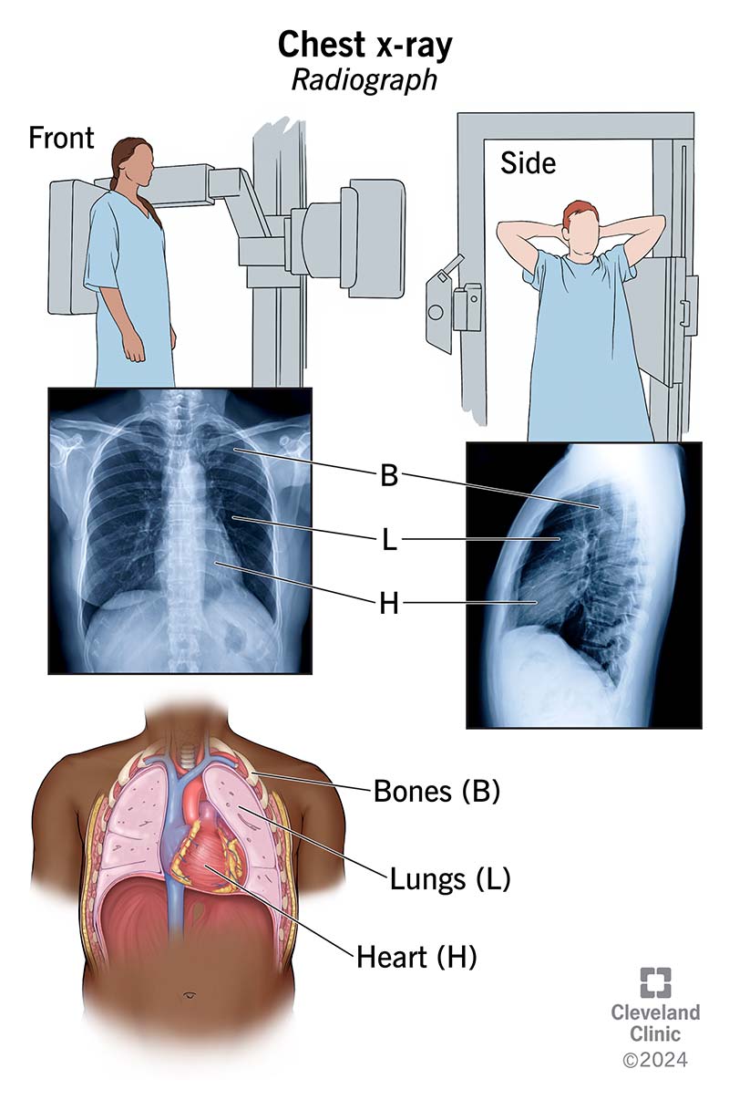 Front and side views of chest X-ray, showing bones, lungs and heart.