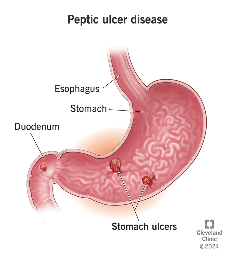 แผลในกระเพาะอาหาร