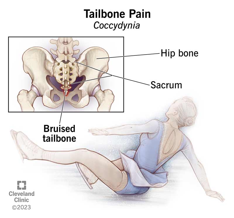 Tailbone pain can occur if you bruise your tailbone (located just below your sacrum) during a fall or other trauma.