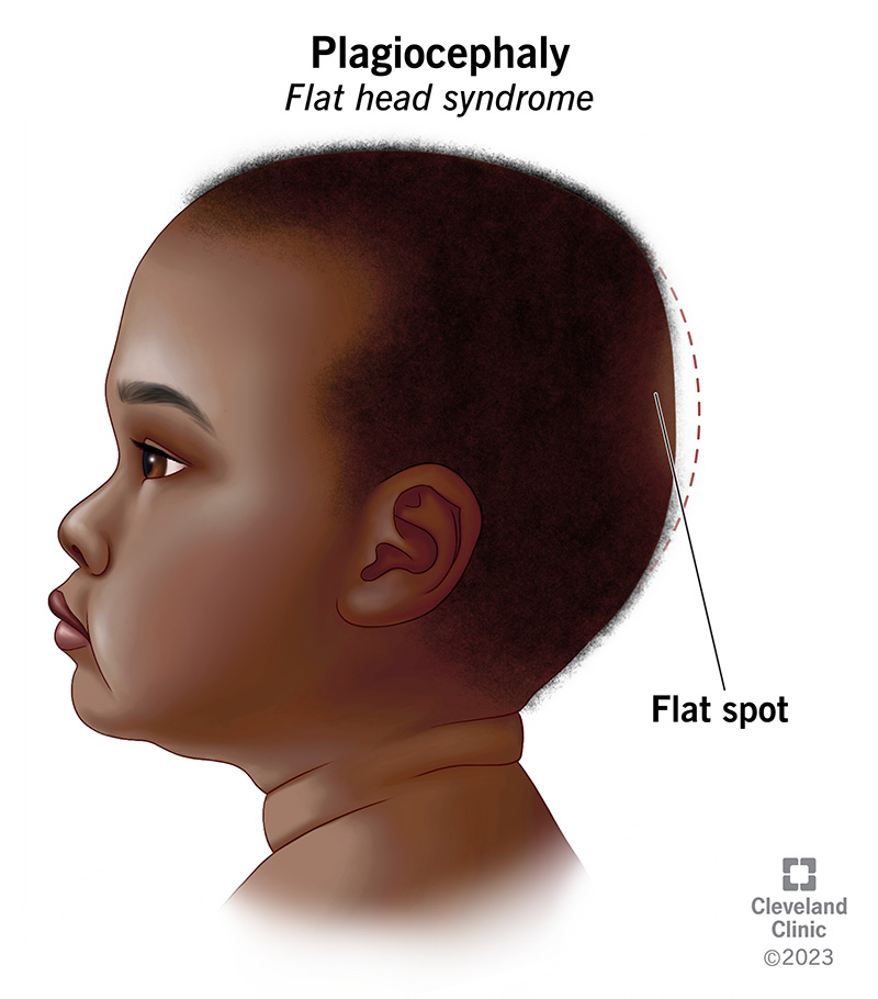 A baby with a flat spot on their head due to positional plagiocephaly (flat head syndrome).