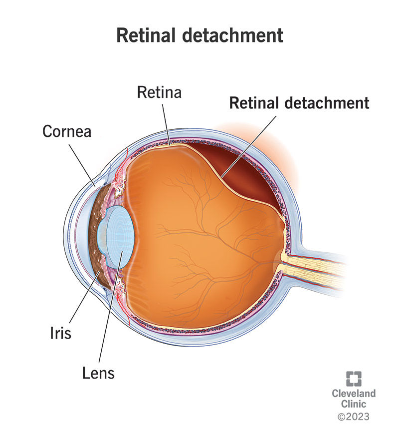 Your retina, an eye part like your iris, cornea and lens, can pull away from supporting tissue, resulting in retinal detachment.