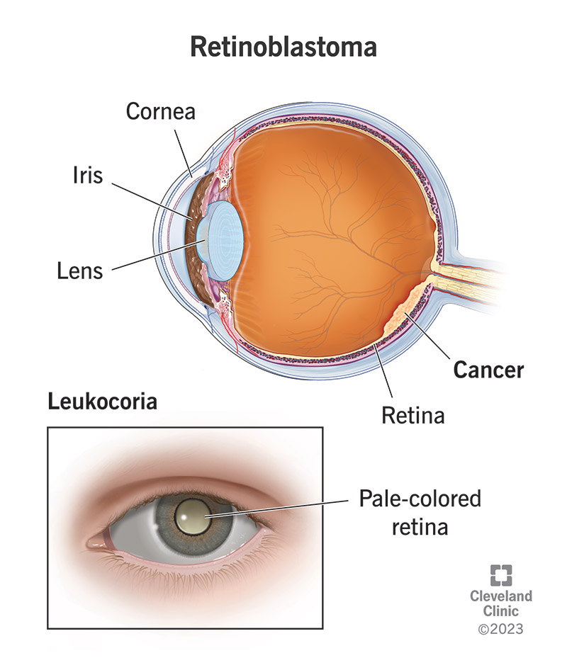 A pale-colored pupil of retinoblastoma, a cancer of the retina at the back of your eye.