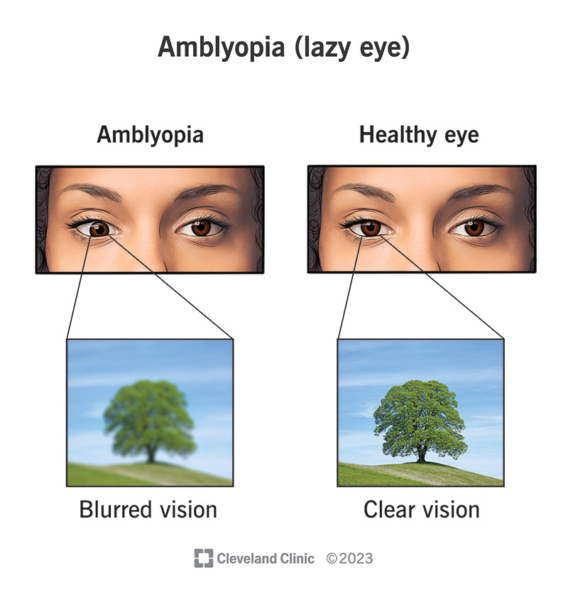 Ambylopia causes one eye to have blurry vision.