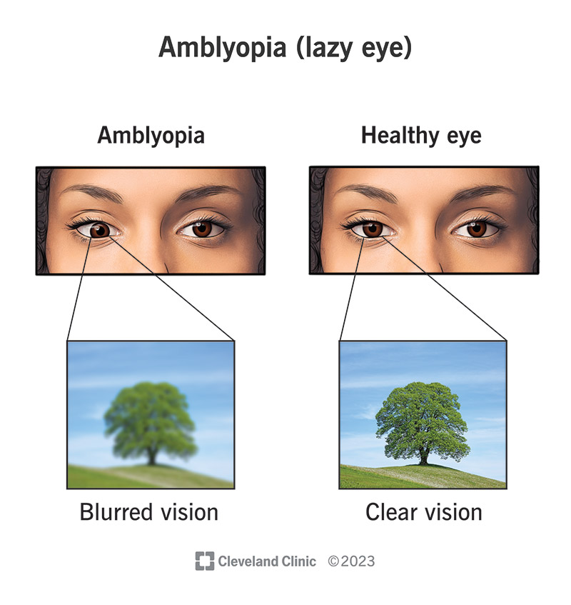 Lazy Eye (Amblyopia): Symptoms, Causes & Treatment