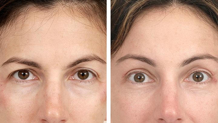 Before and after a brow lift procedure to improve a person’s sagging eyebrows.