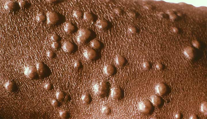 Photo shows large, fluid-filled blisters on the skin of someone with smallpox.