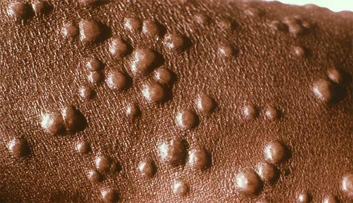 Signs and Symptoms, Mpox, Poxvirus