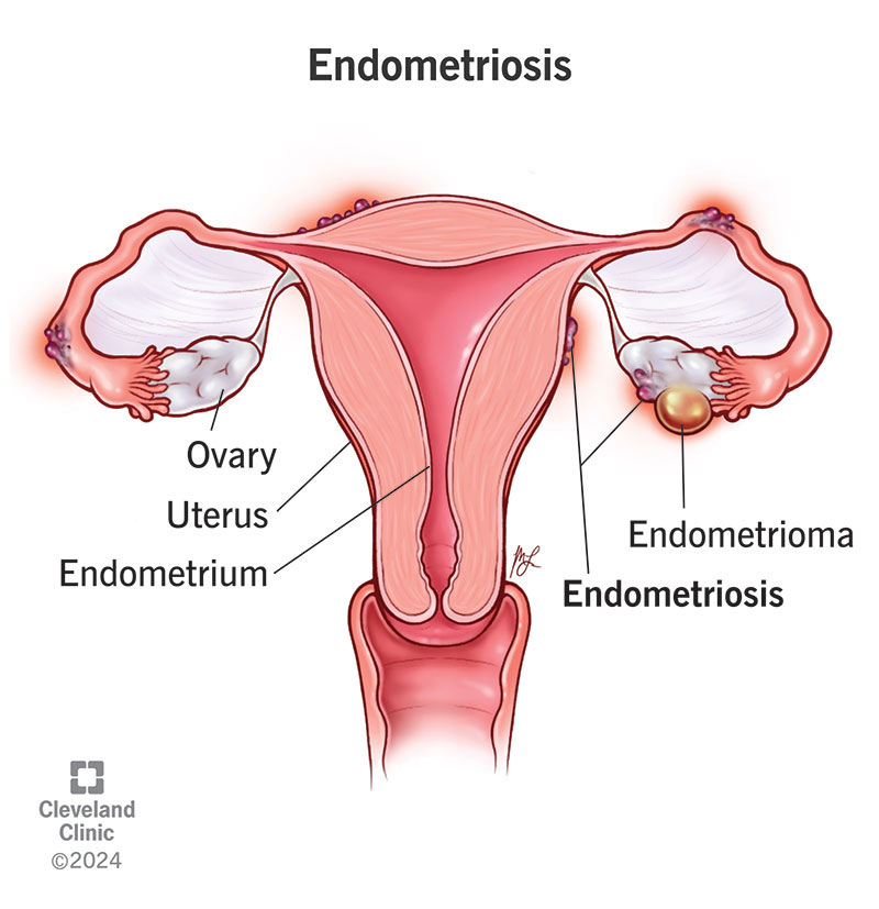 Endometriosis and an endometrioma in the female reproductive system.