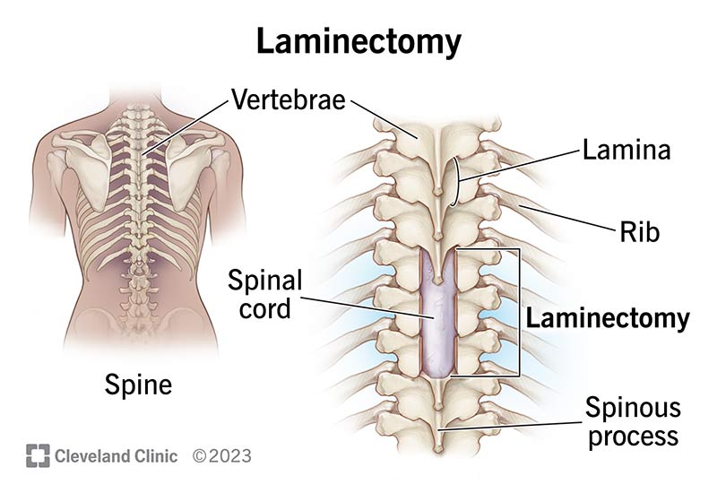 The bones of your spine with the removal of the lamina after a laminectomy.