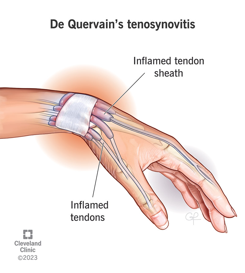 An illustration of de Quervain's tenosynovitis.
