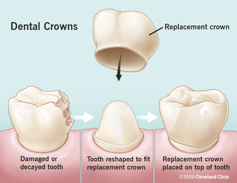 The damaged or decayed tooth is reshaped and a dental crown is placed on top of the tooth.