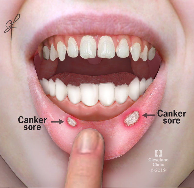 Canker sores show up inside the mouth on the lower lip, unlike cold sores.