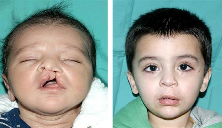 Before and after image of an infant boy with a cleft lip next to a photo of the same boy as a toddler after a cleft lip repair.
