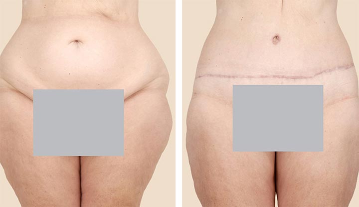 A person before and after liposuction surgery on their abdomen.