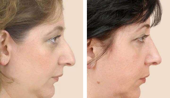A person’s nose before and after rhinoplasty (nose job) surgery.