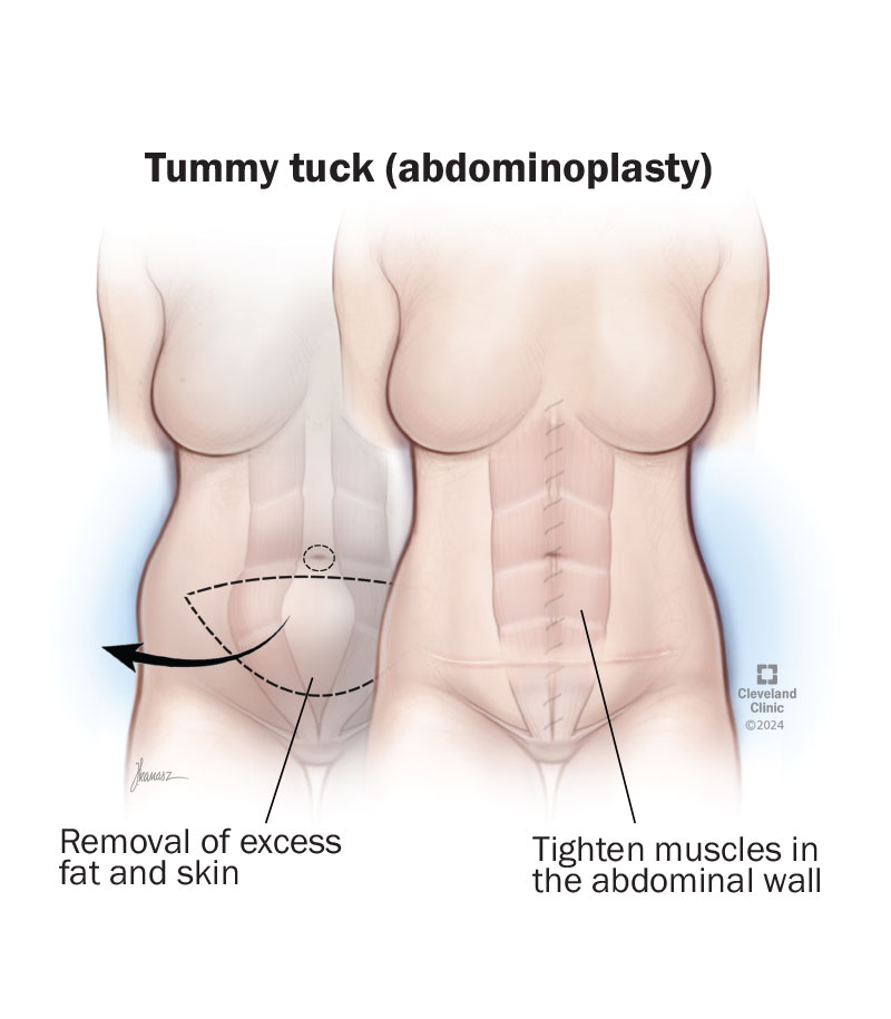 Before and after a tummy tuck (abdominoplasty) procedure to remove excess fat and skin and tighten abdominal muscles.